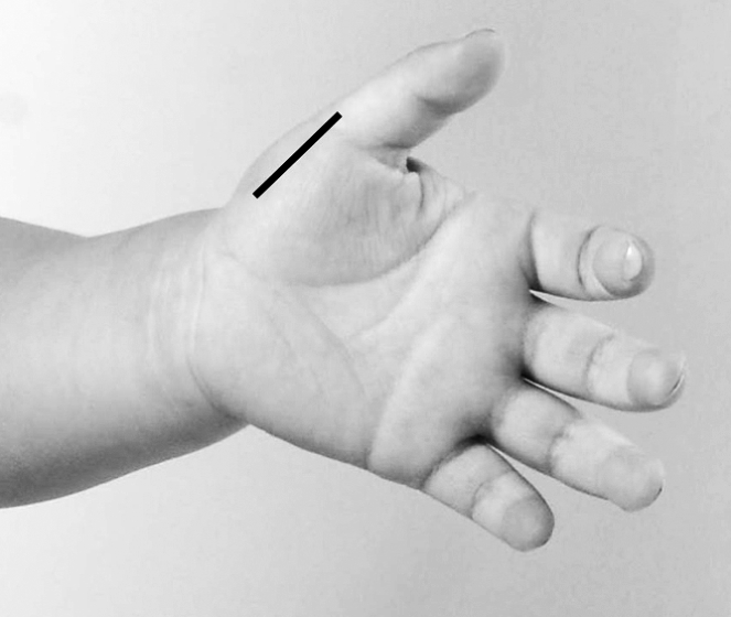 儿童扁桃体肥大最简单的偏方,小儿扁桃体肥大反复发炎怎么办