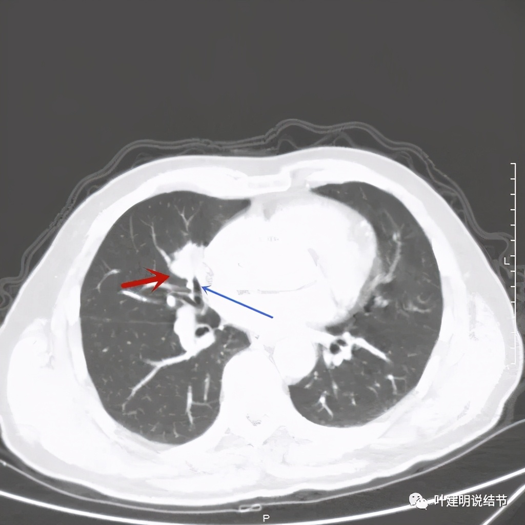 实性结节影要不要紧,实性结节穿刺活检为良性