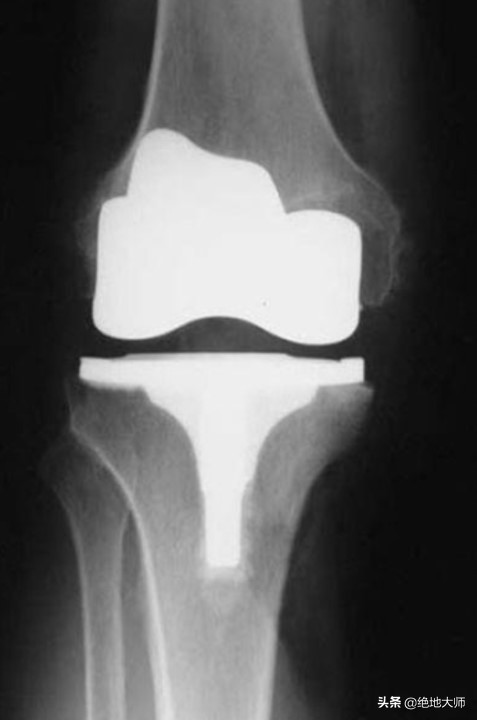 非创伤性膝关节疼痛的评估和神经调控康复治疗