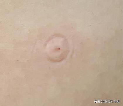 糖尿病注射胰岛素的器械在哪里买,糖尿病胰岛素无针注射器价格表