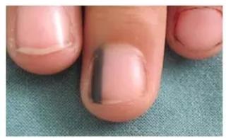 指甲问题对应身体哪里有问题,指甲的各种病变及解决办法