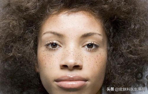 中药点斑好还是激光祛斑好,脸上有斑打激光过后吃有讲究吗