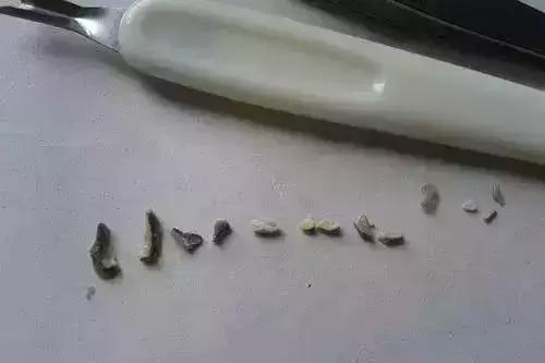 牙结石自己用手抠掉了,你用手抠过牙结石吗