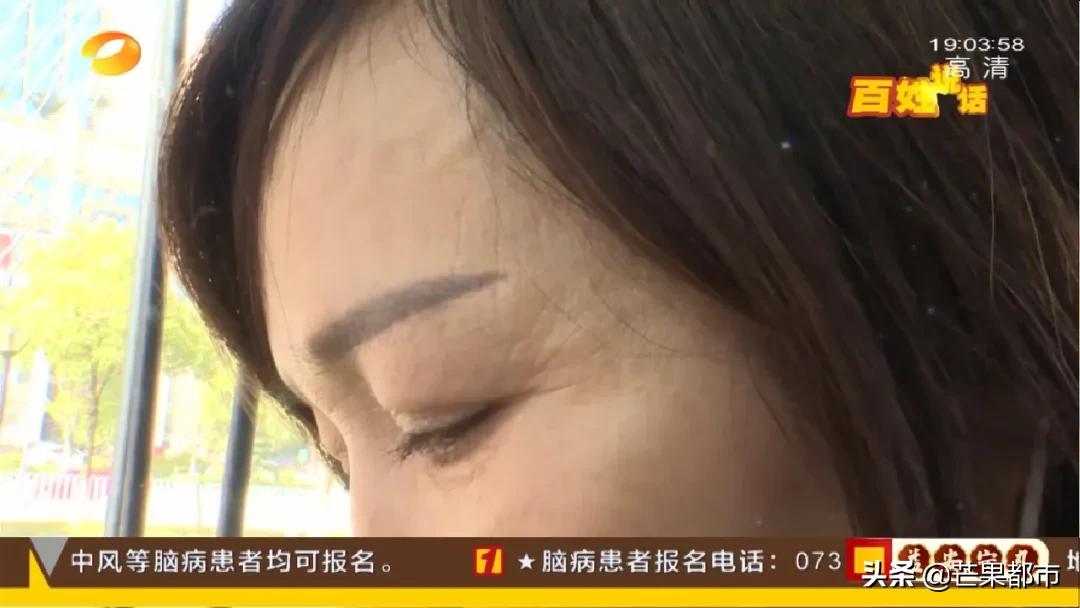 长沙法令纹改善,手术去除法令纹的效果到底怎么样