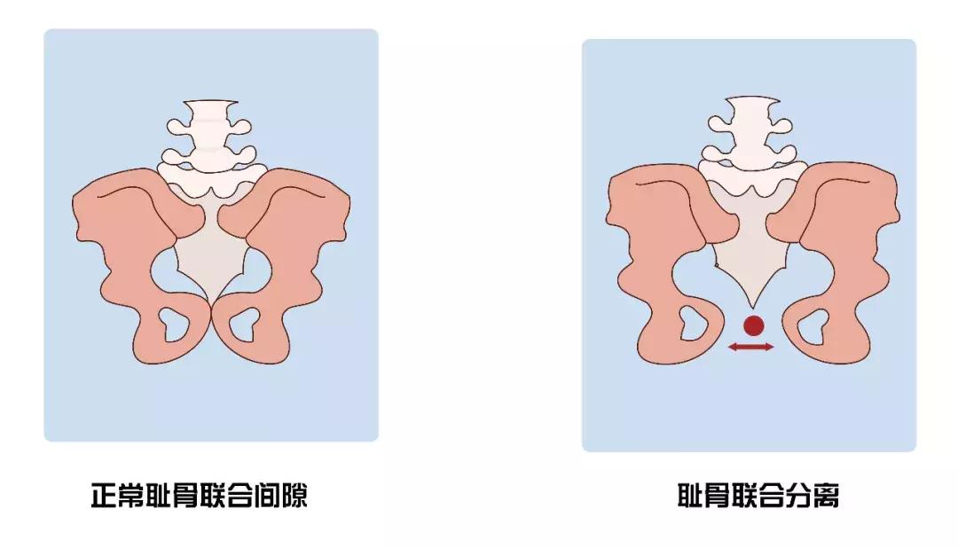 孕期耻骨分离痛是什么原因,孕期一侧耻骨疼怎么缓解