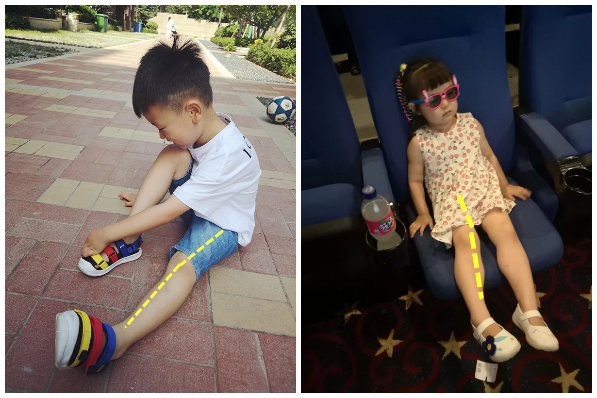 小孩喜欢勾腿是为什么,幼儿罗圈腿会自己好吗