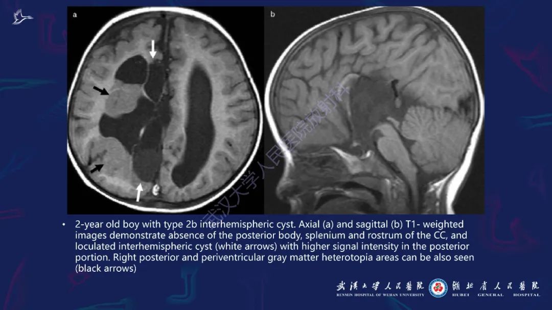 胼胝体肿瘤影像鉴别,胼胝体病变影像诊断