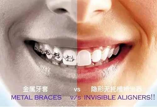 阿娇大龅牙,阿娇整牙