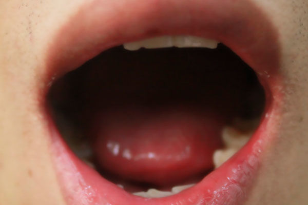 舌头尖变红是怎么回事,舌头变红了而且还痛