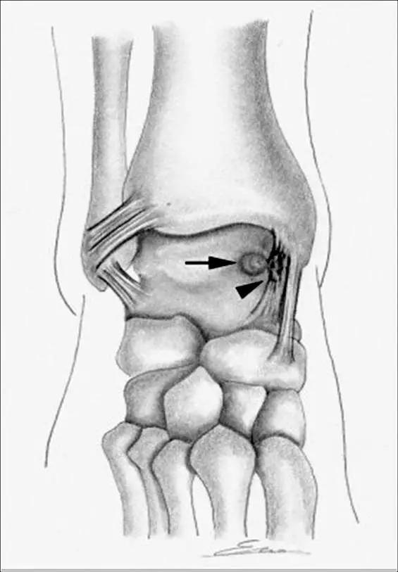 踝关节撞击症问诊,踝关节撞击综合征的x线表现