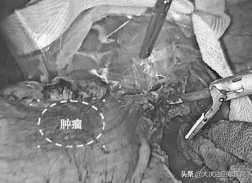 84岁老人直肠癌微创手术,直肠癌手术成功无转移