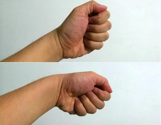 手腕腱鞘炎疼痛如何根除,手腕腱鞘炎疼痛如何缓解