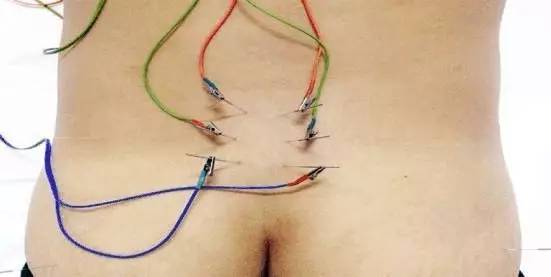 腰椎间盘突出自愈分享,腰椎间盘突出患者治疗案例