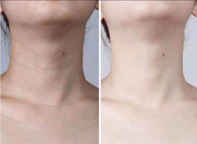 脖子上的颈纹怎么锻炼才能淡化,去脖子颈纹最好的方法真实有效