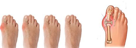 痛风关节发热肿痛应该怎么缓解,痛风关节红肿疼痛怎么办