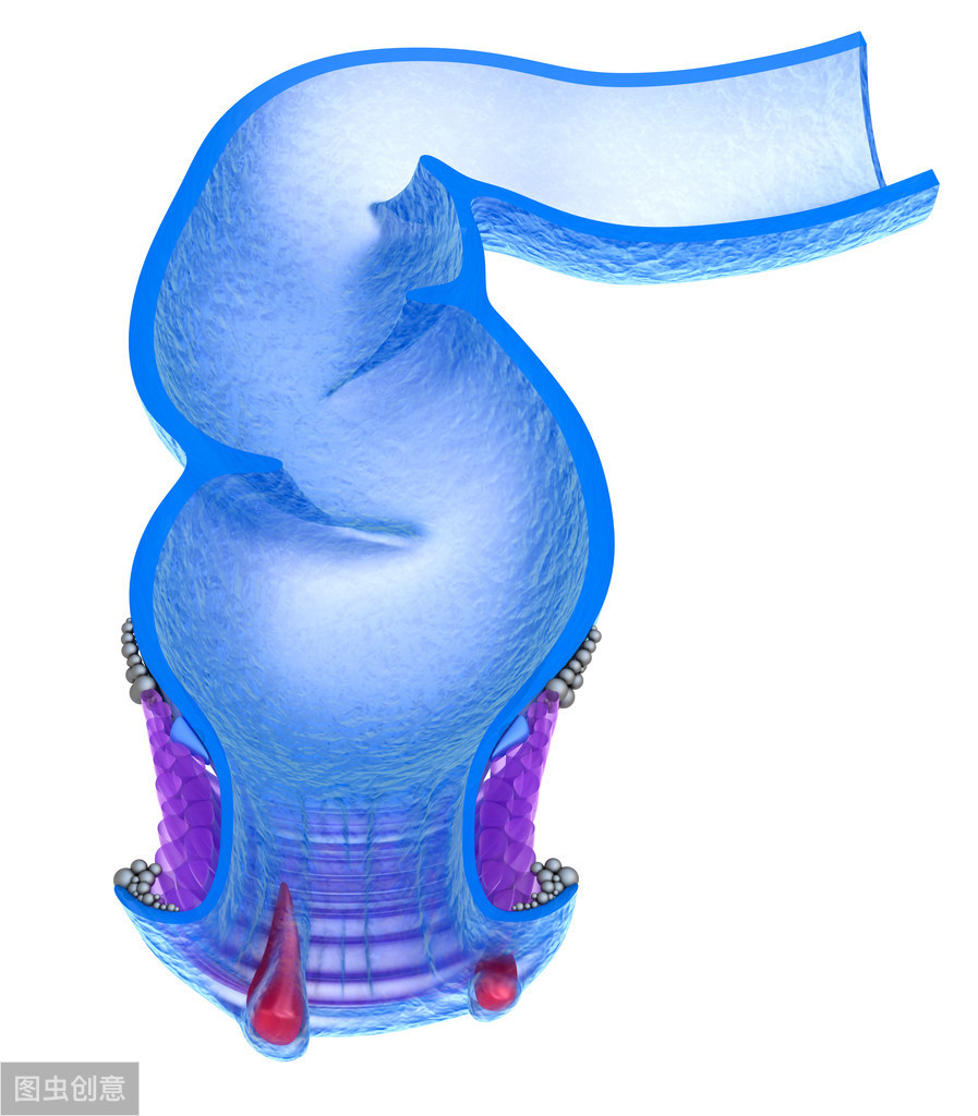 肝硬化引起痔疮便血,肝硬化病人为什么会出现便血症状
