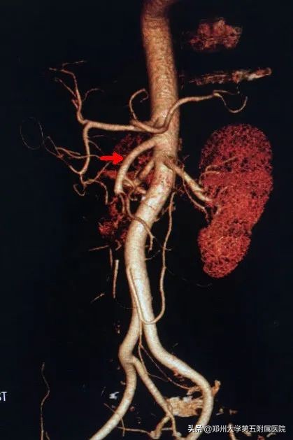 房颤患者的噩梦之不一样的急性腹痛——肠系膜上动脉栓塞