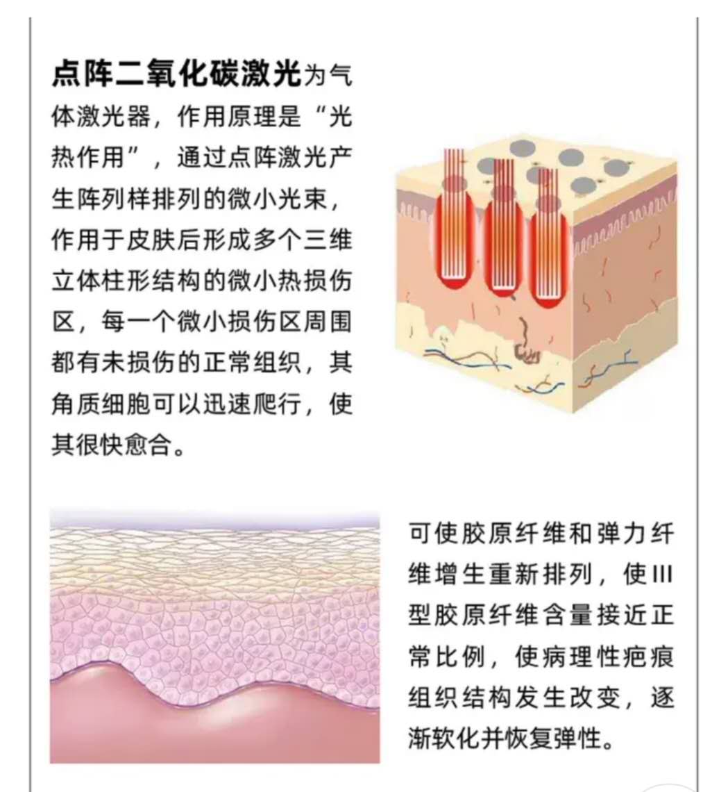 如果是剖腹产疤痕体质怎么办,剖腹产难看的疤痕教你轻松美化