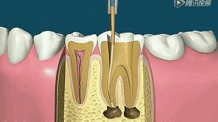 根管治疗后期症状,根管治疗全过程真的很痛吗