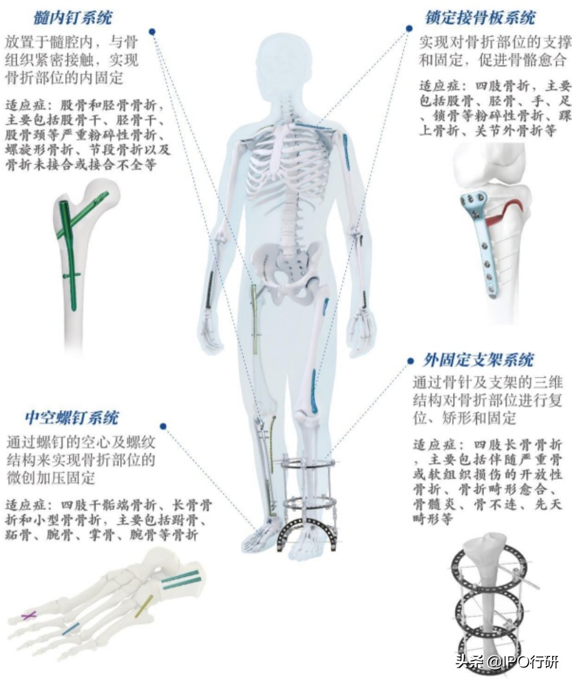 中国骨科植入物排名,骨科植入效果怎么样