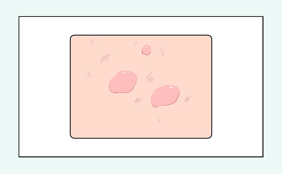 脸上的红疙瘩怎么彻底消除,脸上红疙瘩的种类