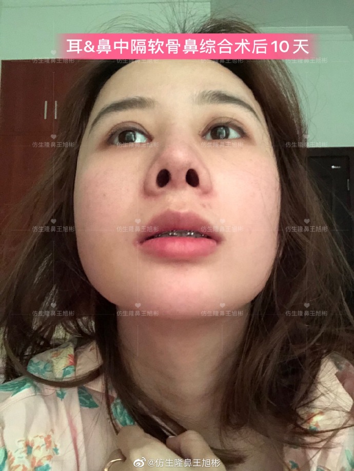 假体隆鼻耳软骨垫鼻尖图片,l型假体耳软骨隆鼻图片