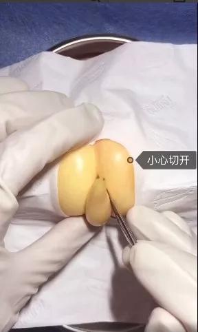 香蕉割包皮，洋葱剖腹产？这是我见过最秀的医生