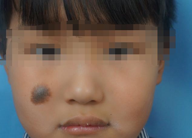 色素痣和黑毛痣的区别,黑毛痣是什么东西