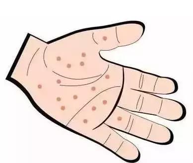 天热手上起水泡怎么回事,天气一热手上就长小水泡怎么回事