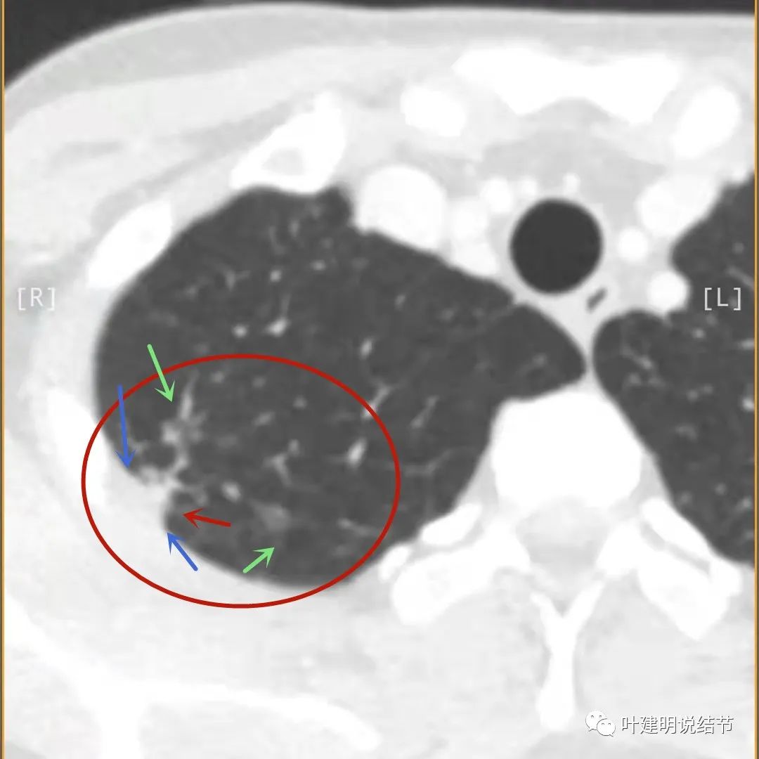 临床诊断孤立性肺结节,空洞型结节一般是什么性质