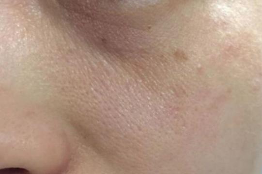 打败毛孔！下一个反孔精英就是你！