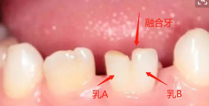 关于宝宝出牙如何护理,宝宝牙齿出牙后怎么护理