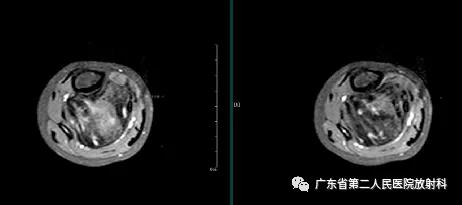 这个病例让我大涨知识：14岁男性右小腿痛性包块