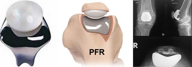 膝关节骨性关节炎症状及治疗,膝关节骨性关节炎诊疗指南下载