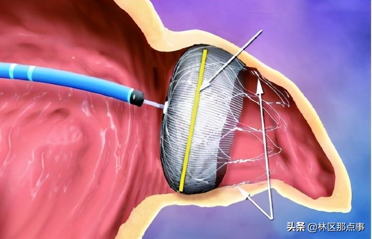 脑梗塞半边瘫手术,东北脑梗介入手术