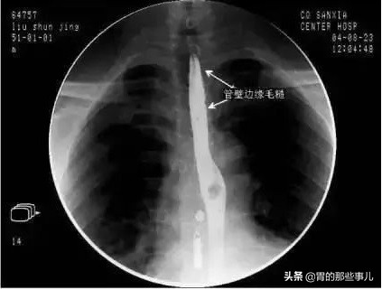 咽喉炎前期癌变症状可以治好吗,一年几次咽喉炎要警惕