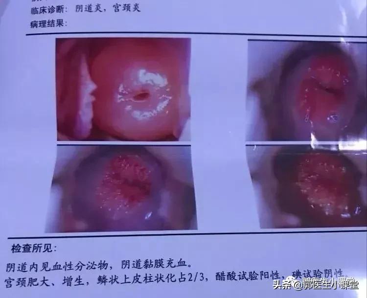 tct检查出血期间可以做吗,做了tct检查后出血多怎么办