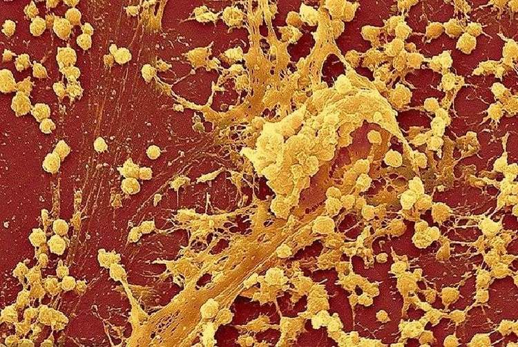 化脓性细菌感染用什么抗生素,化脓性细菌感染有痰用什么抗生素