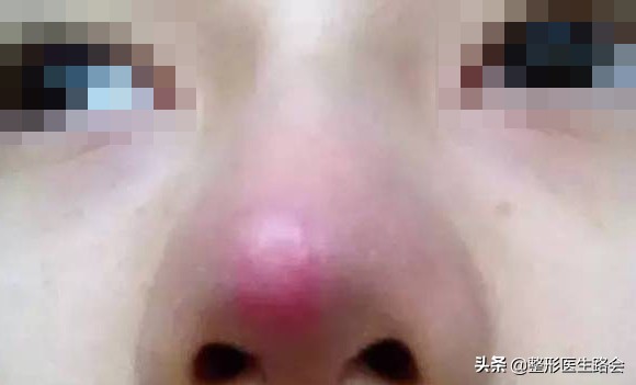 隆鼻前要问清楚的事,做隆鼻手术前你需要了解这些