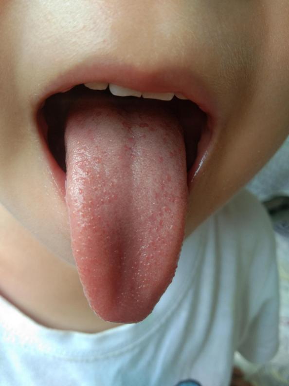 积食不化、反复发热、蒸笼头，问题这么多，从哪里入手好得快