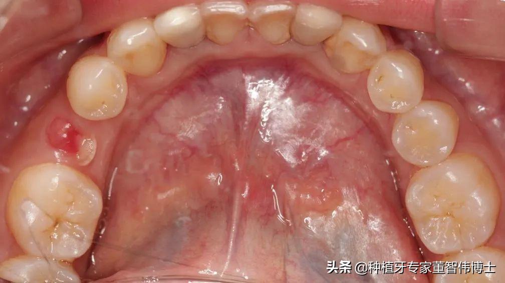 拔牙后即刻种植好还是延期种植好,拔牙后牙槽骨突的修复术视频