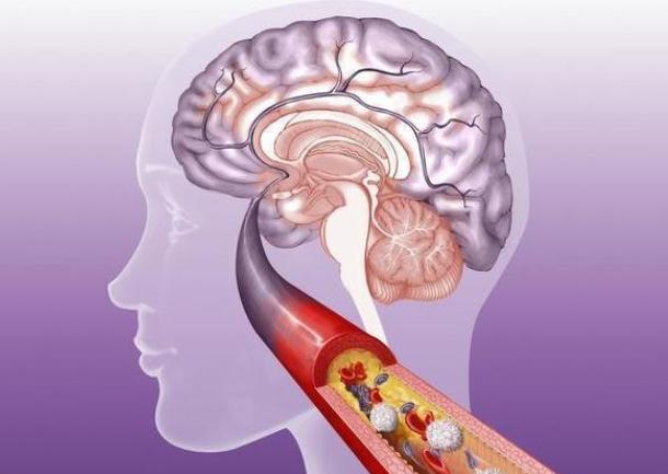 急性脑梗的护理措施,如何预防急性脑梗的发生