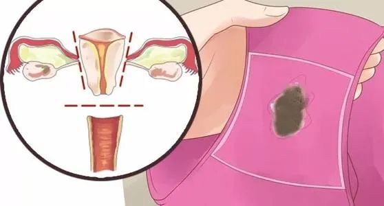 hpv疫苗接种注意事项及禁忌,月经期间可以接种hpv疫苗吗