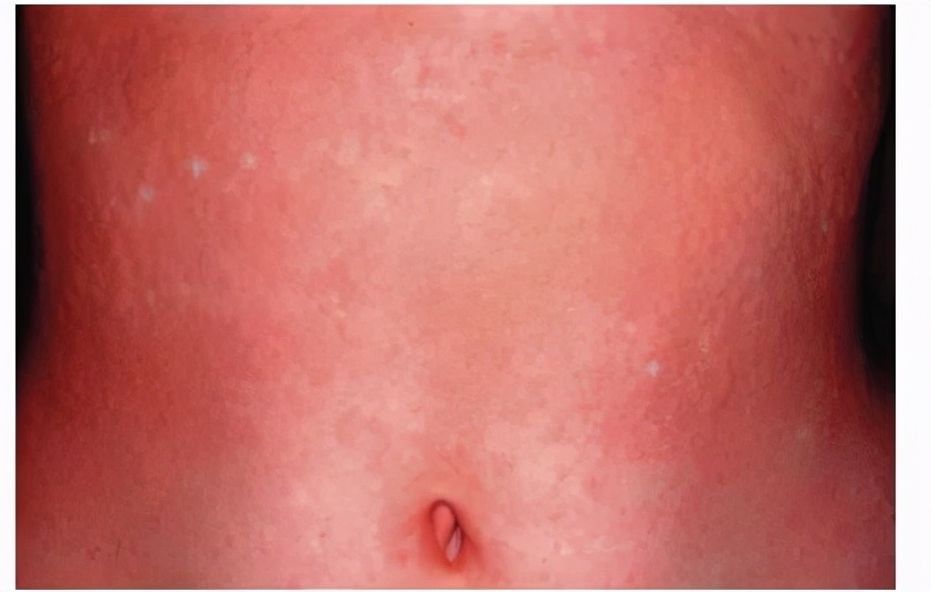 一出汗就痒个不停？胆碱能性*麻疹荨**还能治好吗？