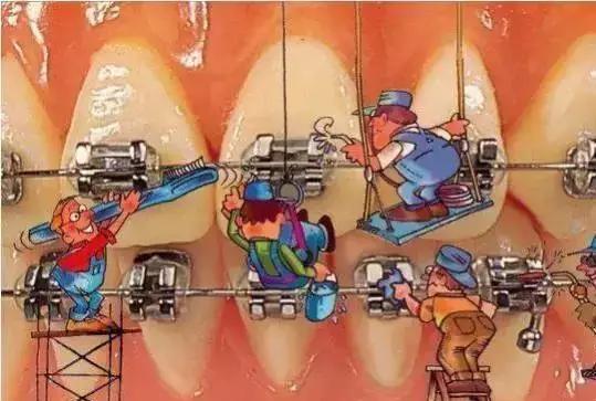 矫正牙齿是如何戴牙套的,矫正牙齿戴牙套需要注意事项