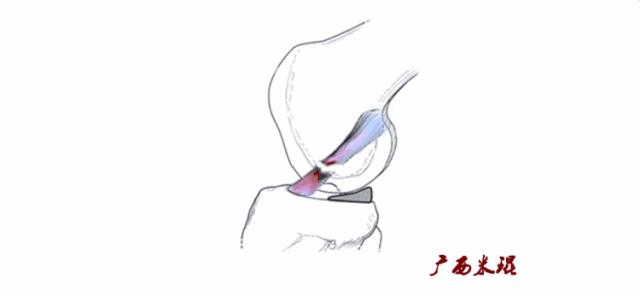 听骨科医生讲的话,听完骨科专家的一段话