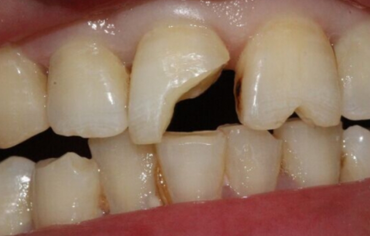 上门牙磕破了一小块怎么办,上门牙磕掉了怎样处理伤口