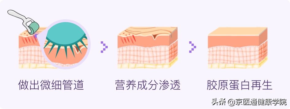 “毛孔粗大”粗的并不是“毛孔”,它是瘢痕呀！三种方法有效解决