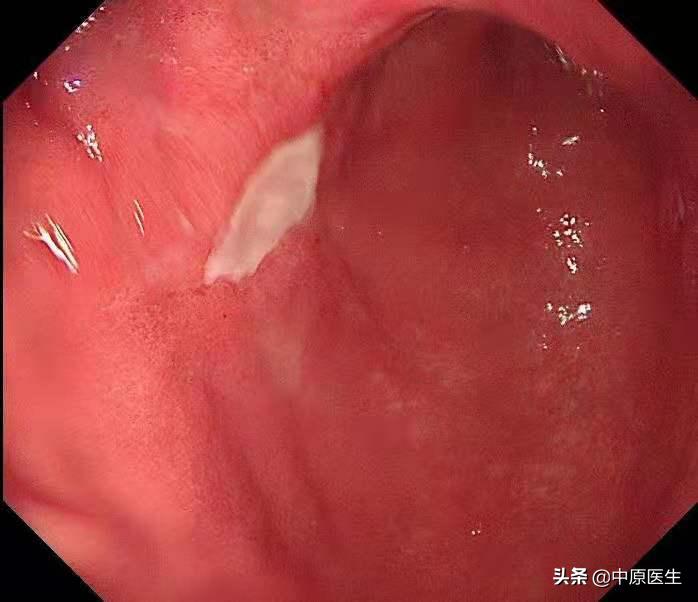 必须活检的胃溃疡:以为是胃溃疡,专家用另一方法放大发现是胃癌