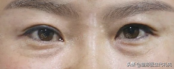 祛眼袋十问十答,提眉祛眼袋泪沟脂肪填充后